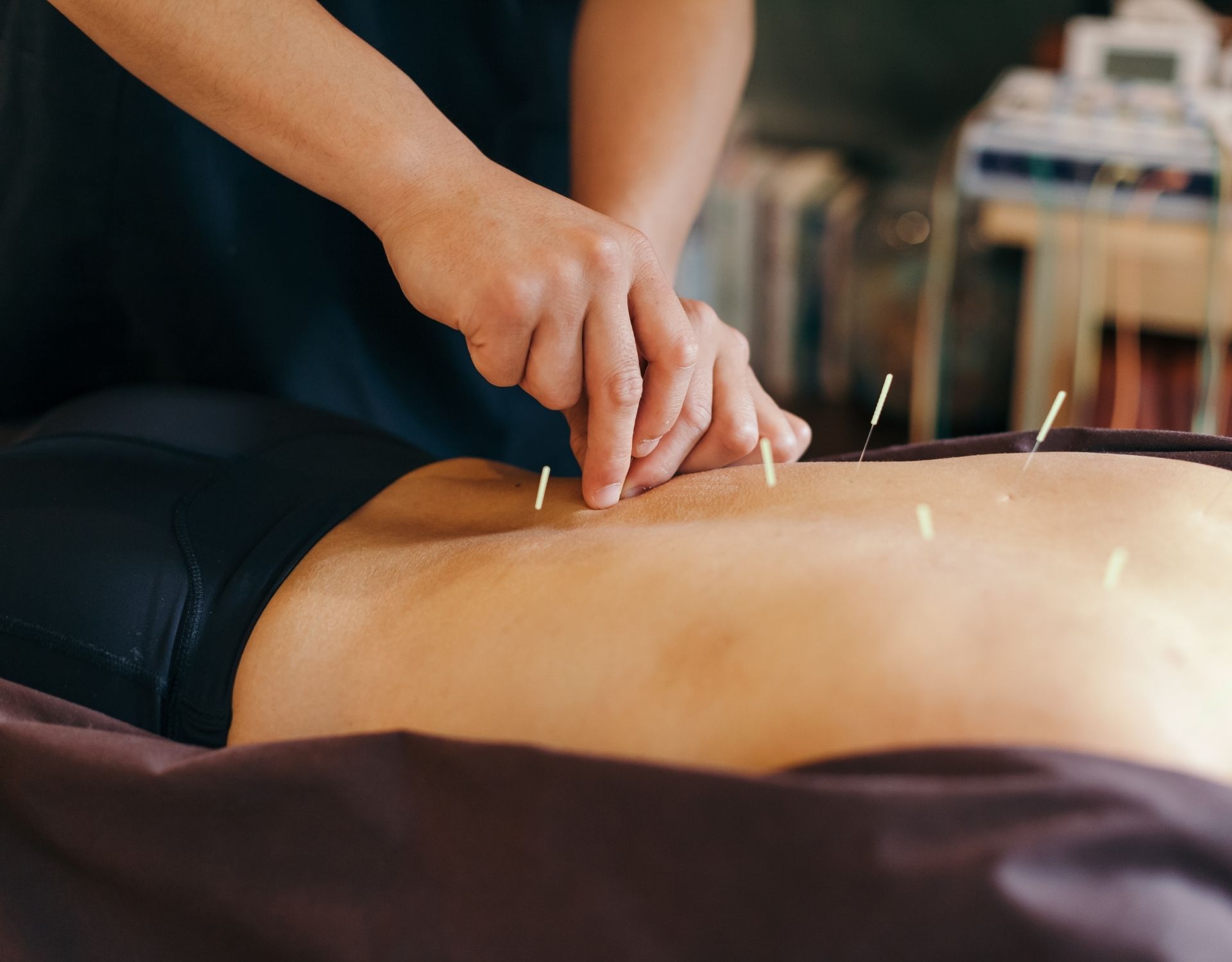 Acupuncture for Pain Conditions